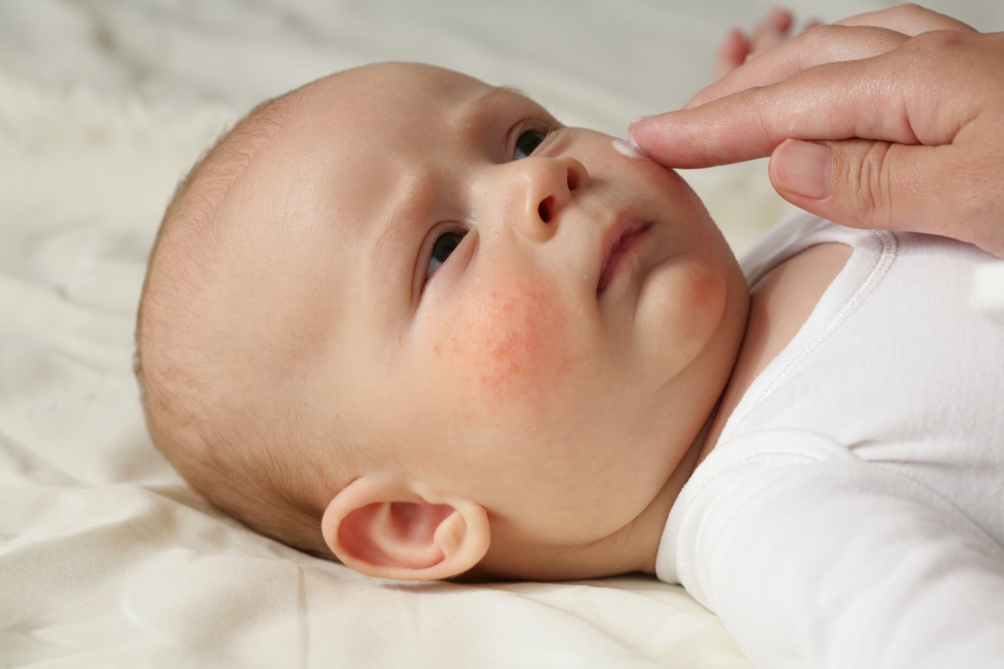 parent putting moisturizer on a child's skin condition